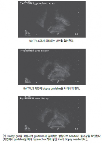 파일:전립선 18.jpg