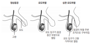 요도하열1.png