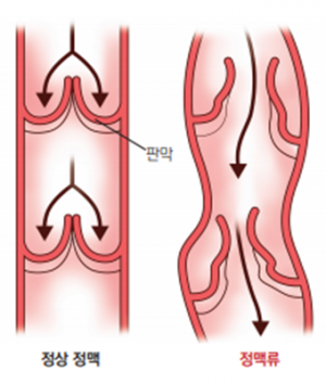 정계정맥류2.png